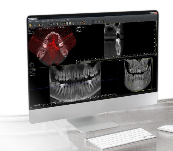 Quickvision 3D Logiciel de planification implantaire