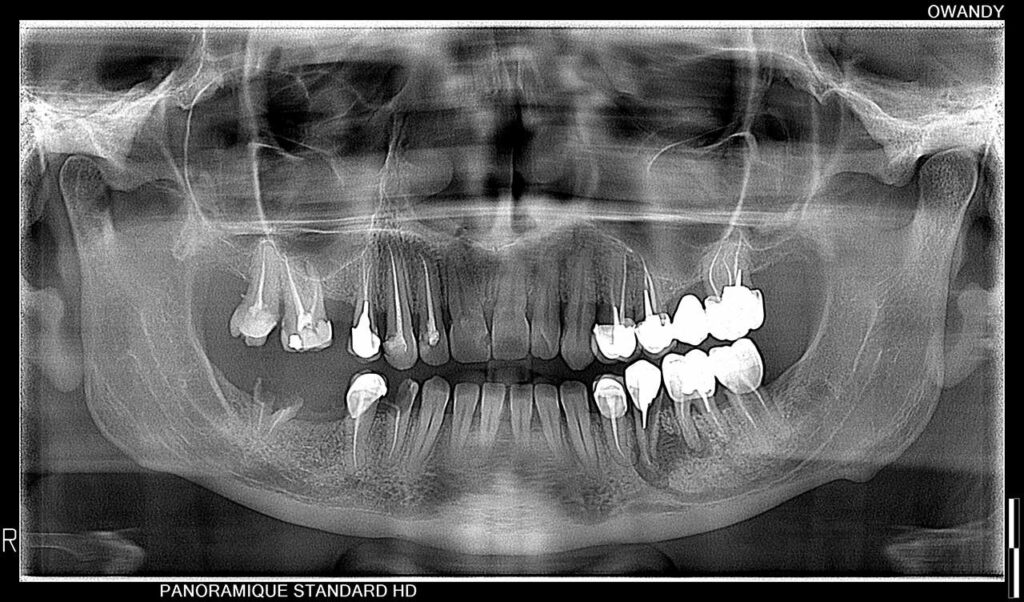Panoramique dentaire
