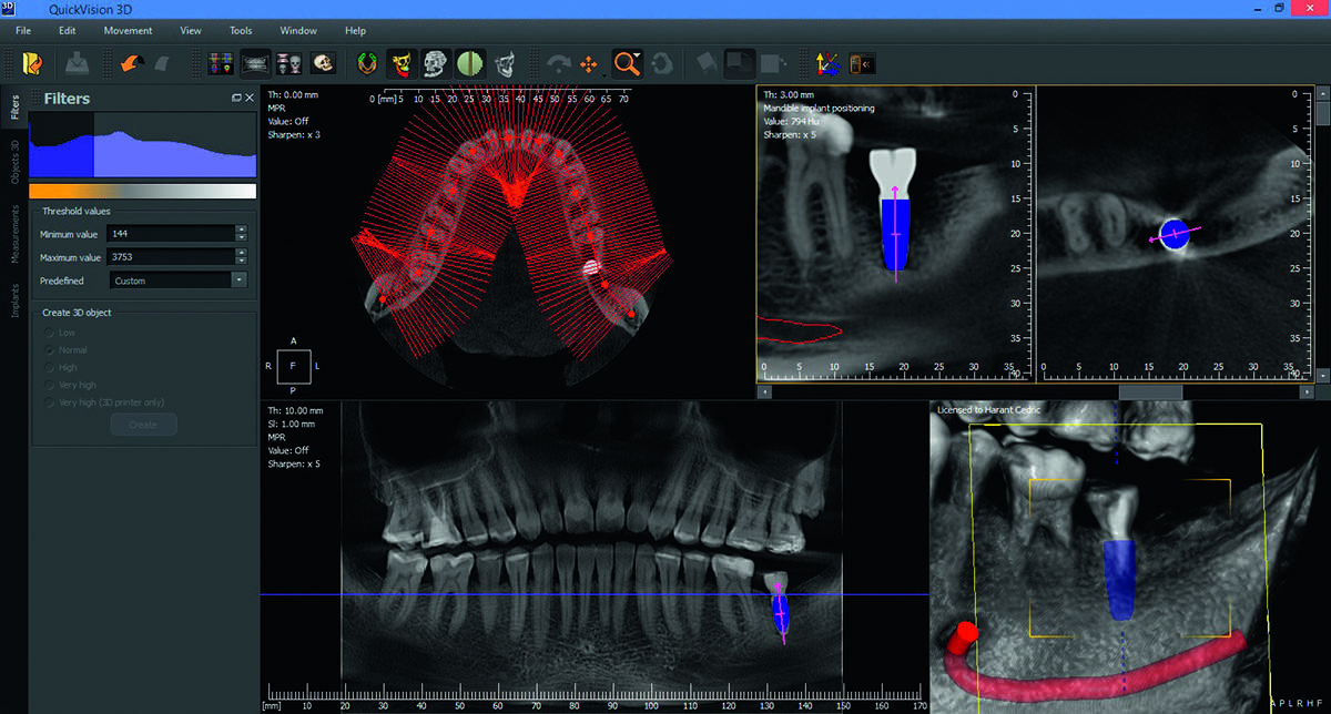 QuickVision 3D Logiciel de planification implantaire